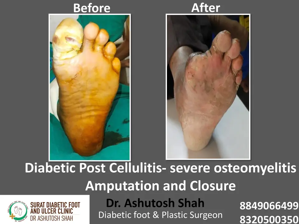 Diabetic Foot  PPT sunita.pptx-7.webp